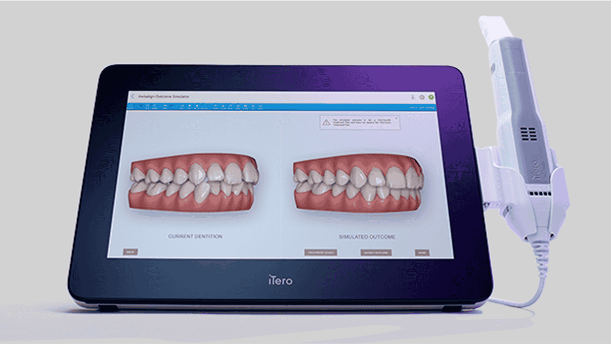 Scanner Intraoral iTero — Invisalign